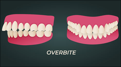 Untreated Overbite