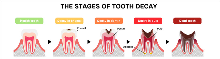 Tooth Decay