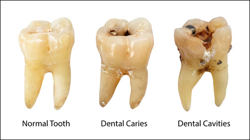 Tooth Decay